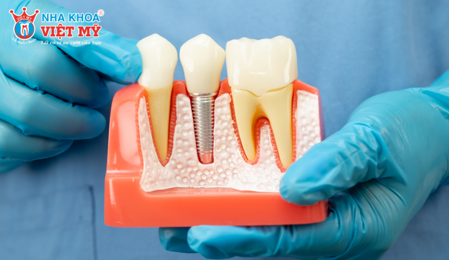 Thời gian trồng răng Implant thường kéo dài từ 3 - 6 tháng