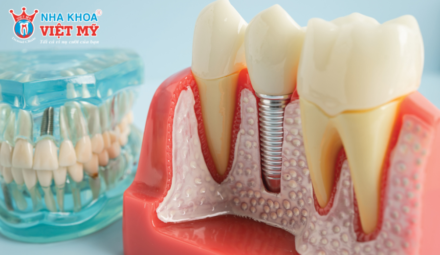 Chăm sóc đúng cách giúp vết thương nhanh lành sau trồng răng Implant