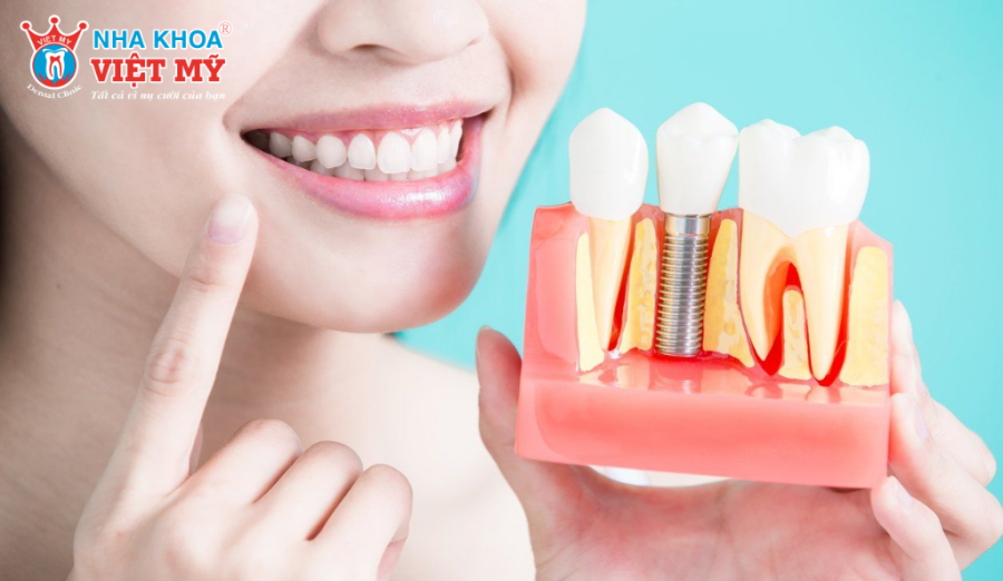 Chăm sóc răng miệng đúng cách giúp rút ngắn thời gian trồng răng Implant