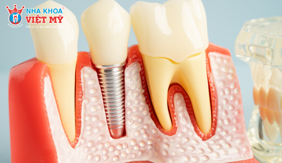 Loại trụ Implant sẽ ảnh hưởng trực tiếp đến thời gian điều trị