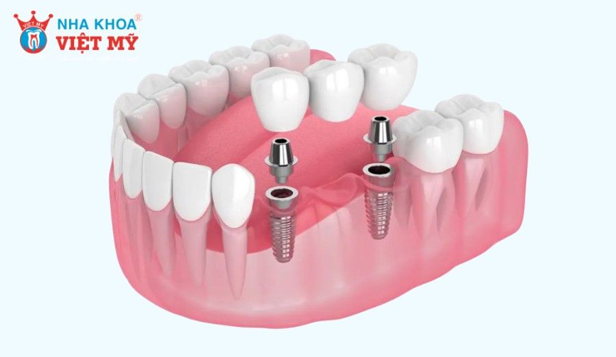 Sau khi gắn răng sứ cố định, bạn có thể ăn nhai gần giống như răng thật