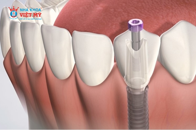 Cấu tạo của Abutment Implant