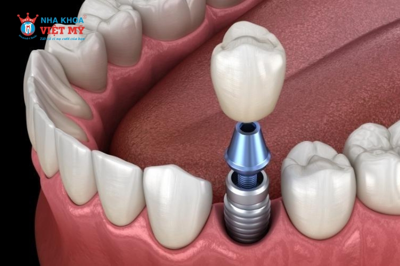 Bạn nên đến cơ sở thẩm mỹ uy tín để được tư vấn từng loại Abutment cụ thể