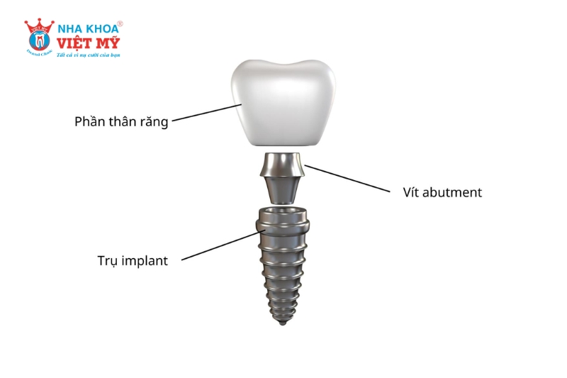 Các loại Abutment Implant thường gặp