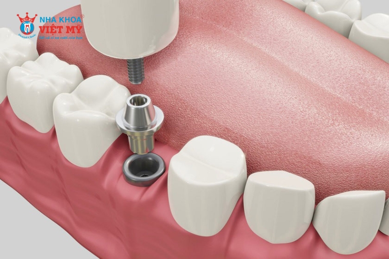 Đặc điểm của Abutment Implant