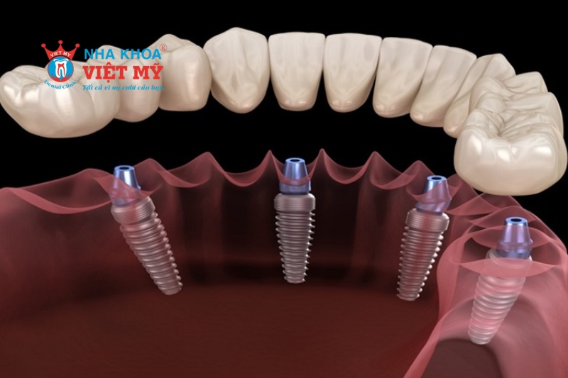 Mất toàn bộ răng thì nên cấy ghép implant