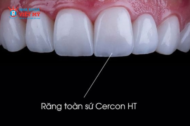 Răng sứ Cercon HT là gì?