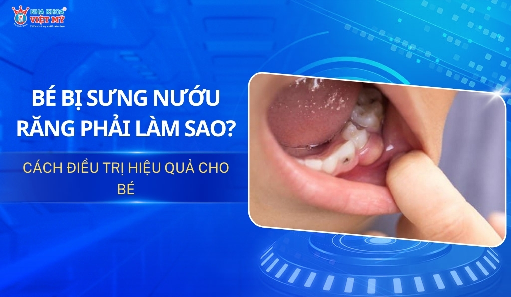 thumbnail bé bị sưng nướu răng phải làm sao