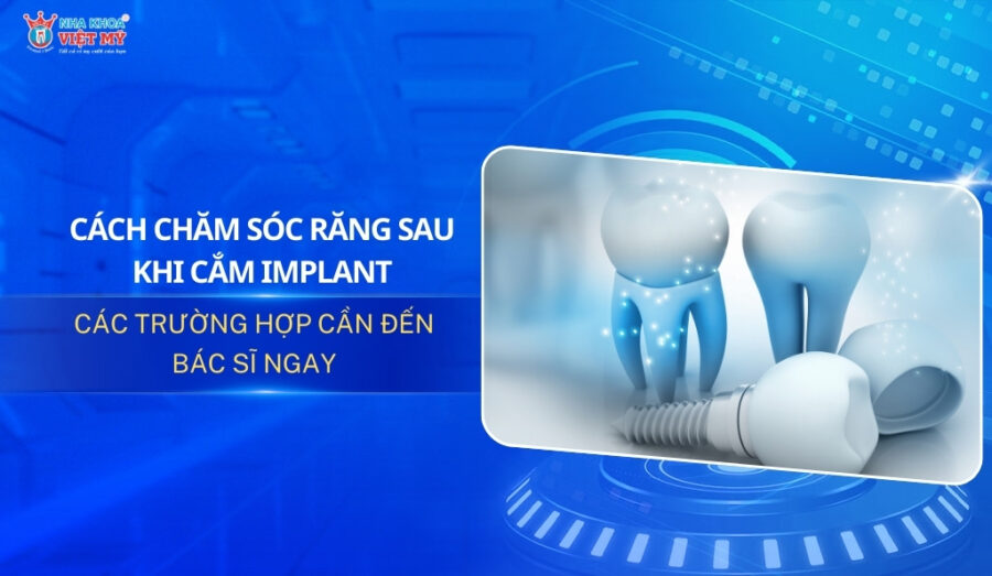 Thumbnail cách chăm sóc răng sau khi cắm implant