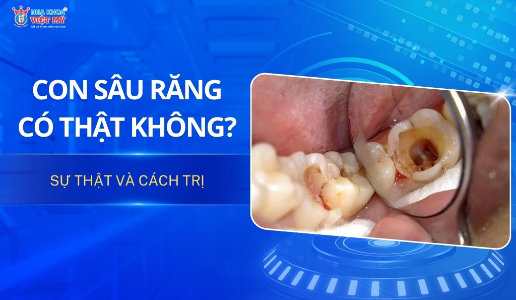 thumbnail con sâu răng trông như thế nào