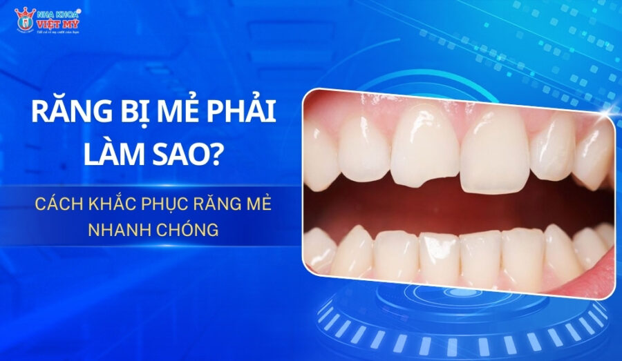 thumbnail răng bị mẻ phải làm sao