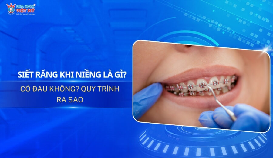 Thumbnail siết răng khi niềng