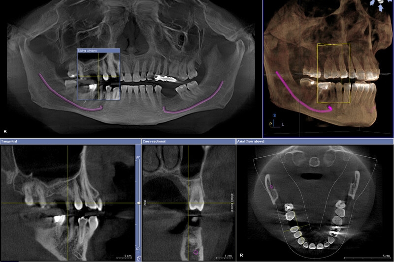 Chụp CT kiểm tra xương, răng