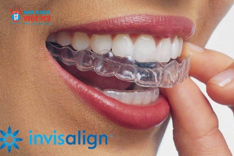 niềng răng trong suốt Invisalign