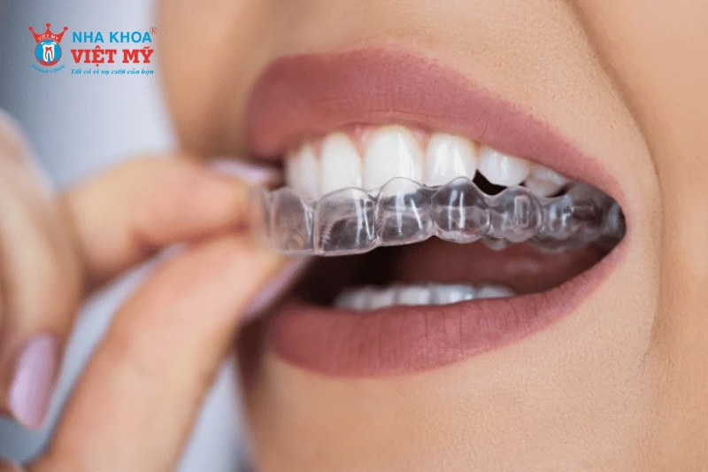 niềng răng trong suốt Clear Aligner