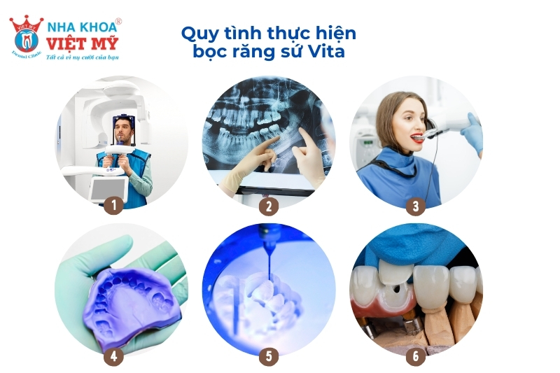 Quy trình thực hiện bọc răng sứ Vita