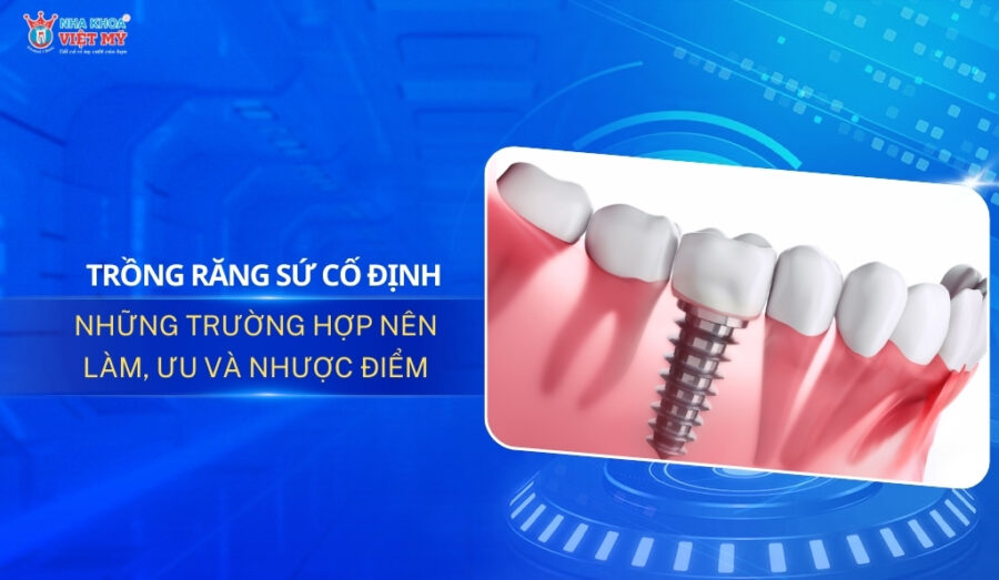 Thumbnail trồng răng sứ cố định