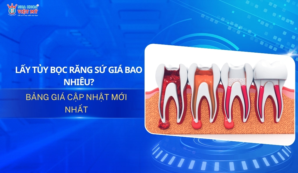 Thumbnail lấy tủy bọc răng sứ giá bao nhiêu