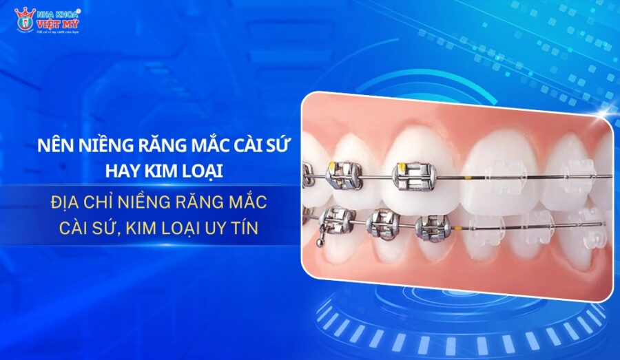 Thumbnail nên niềng răng mắc cài sứ hay kim loại