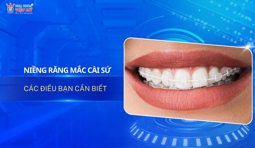 Thumbnail niềng răng mắc cài sứ