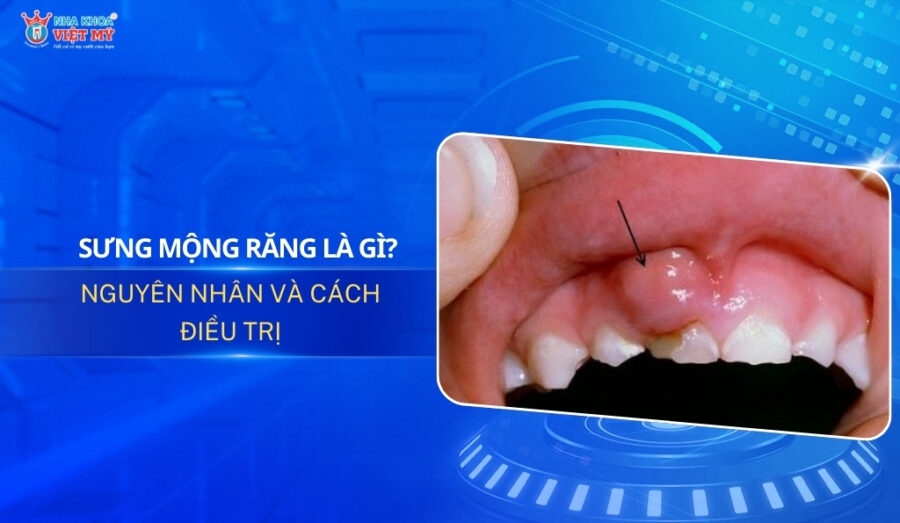 thumbnail sưng mộng răng là gì