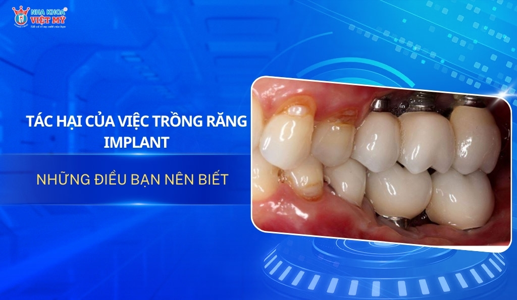 Thumbnail tác hại của việc trồng răng implant