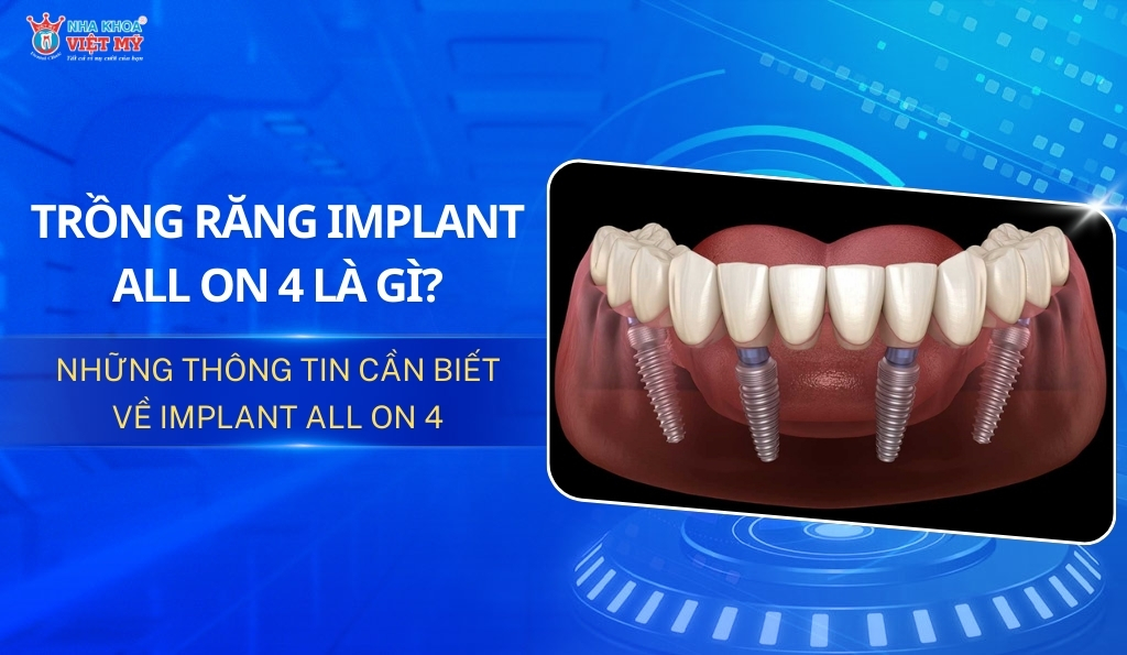 thumbnail trồng răng implant all on 4 là gì