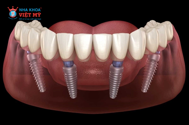 Trồng răng implant all on 4 là gì?