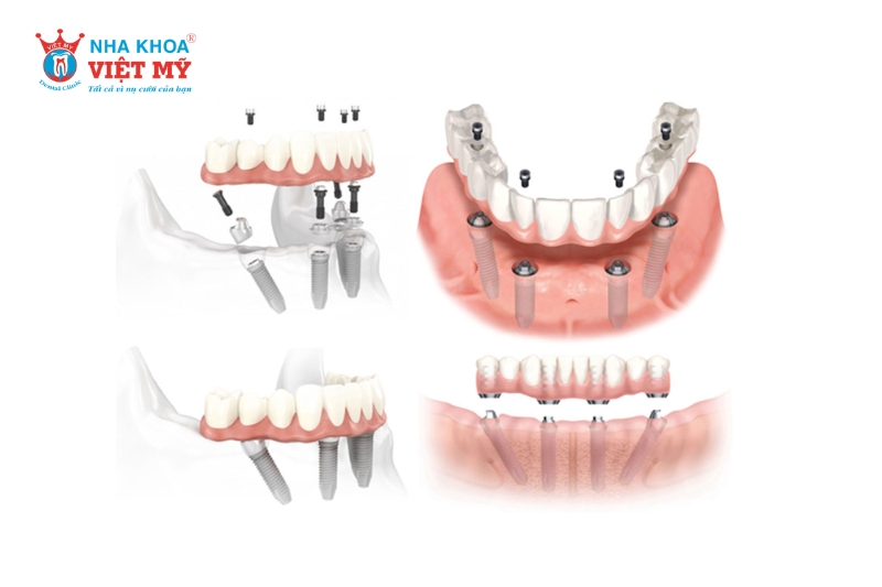 Quy trình trồng răng Implant All-on-4