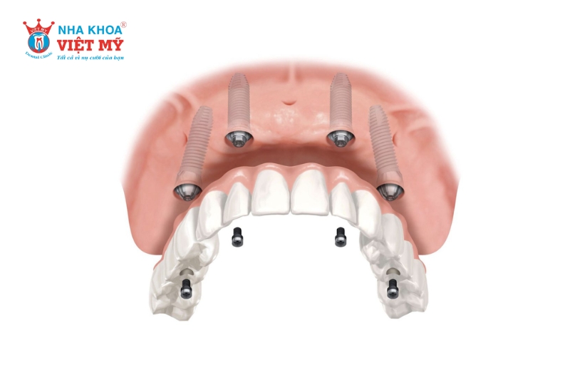 Rủi ro khi thực hiện Implant All-on-4