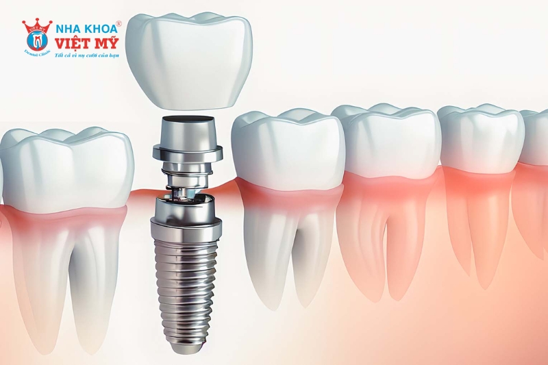 tìm hiểu về trồng răng implant