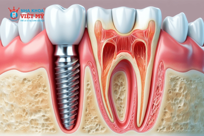 Trồng răng Implant giá rẻ có tốt không?