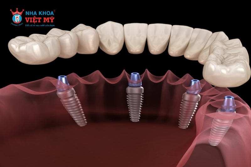 phương pháp cấy ghép implant all on 4