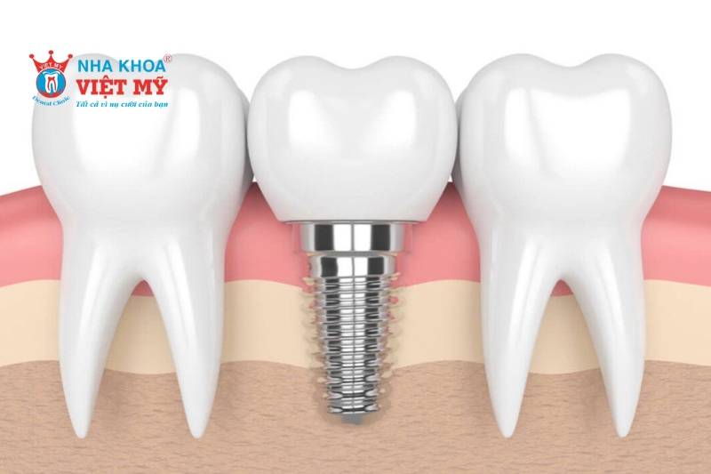 Phương pháp ghép xương Implant nào cũng có ưu và nhược điểm khác nhau