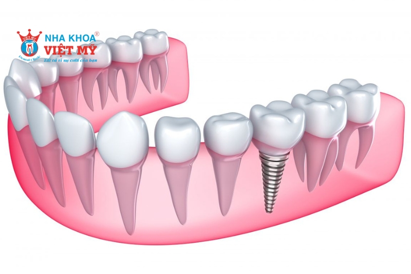 Vậy, ghép xương trước khi trồng răng Implant có bắt buộc không?