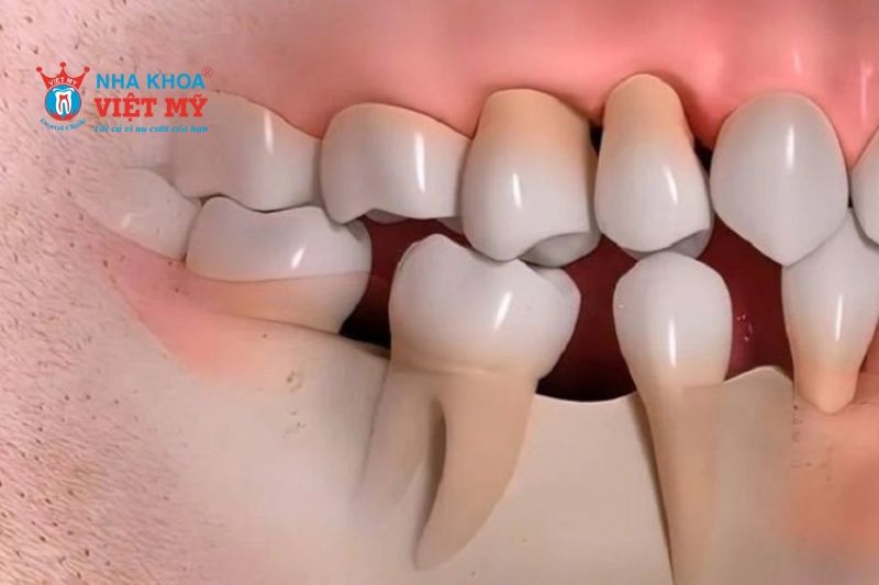 Khe răng quá hẹp khiến việc cắm trụ Implant vào xương hàm không được đảm bảo