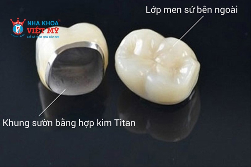 Răng sứ Titan nâng cấp từ răng sứ kim loại thường