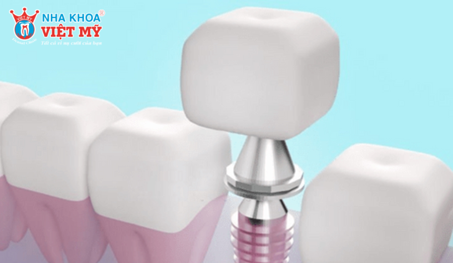 Trụ Implant Straumann nhanh chóng đạt độ ổn định chỉ sau lần đầu cấy ghép