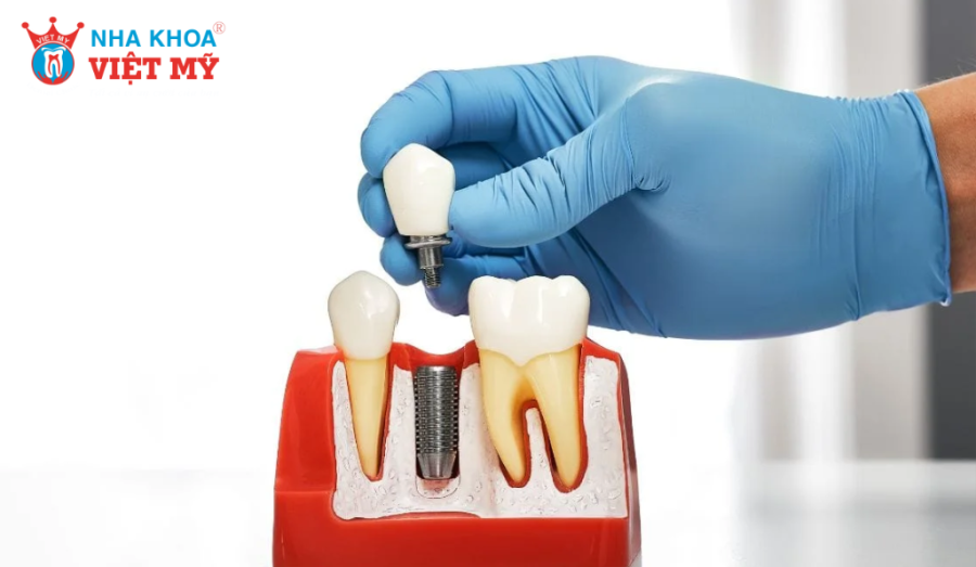 Tuổi thọ của trụ Implant Straumann có thể kéo dài đến 20 năm