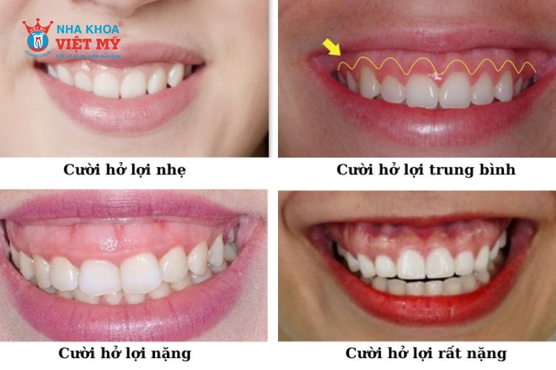 Các mức độ cười hở lợi