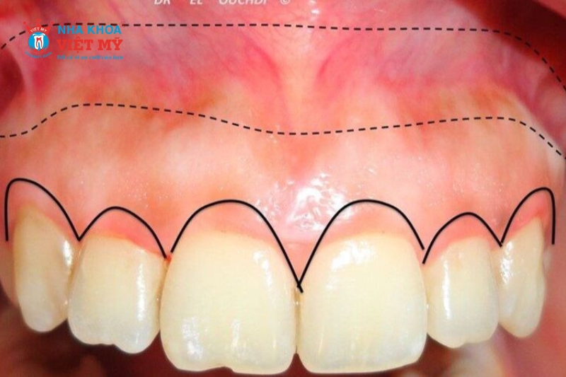 Phẫu thuật điều trị cho người cười hở lợi