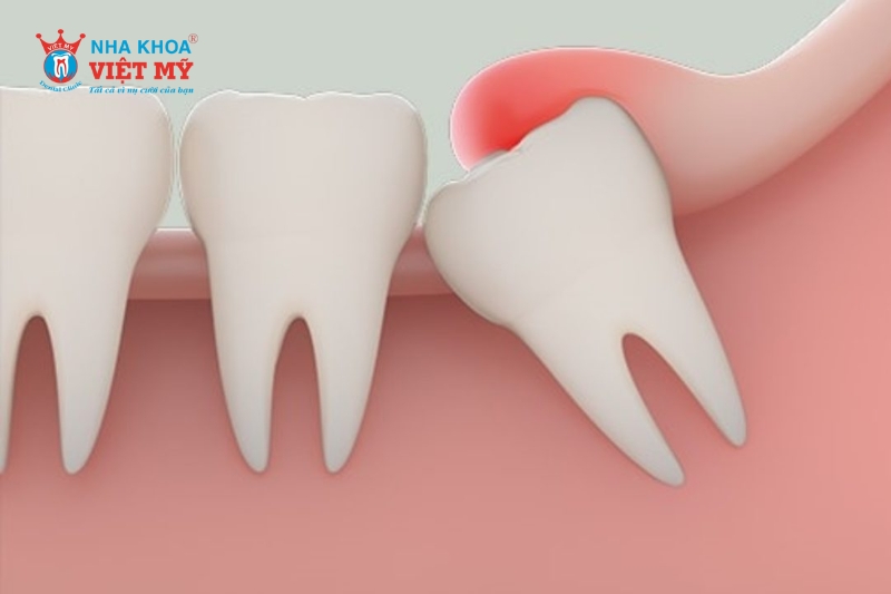 Răng khôn mọc lệch hay mọc ngang sẽ gây ra tình trạng đau nhức và ảnh hưởng đến răng bên cạnh