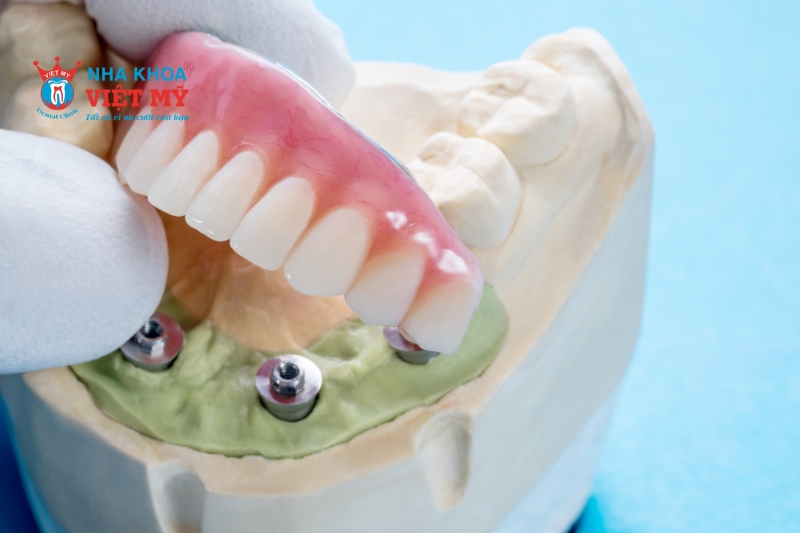 Số lượng và chất lượng xương hàm tại nơi cấy ghép Implant ảnh hưởng thời gian trồng răng