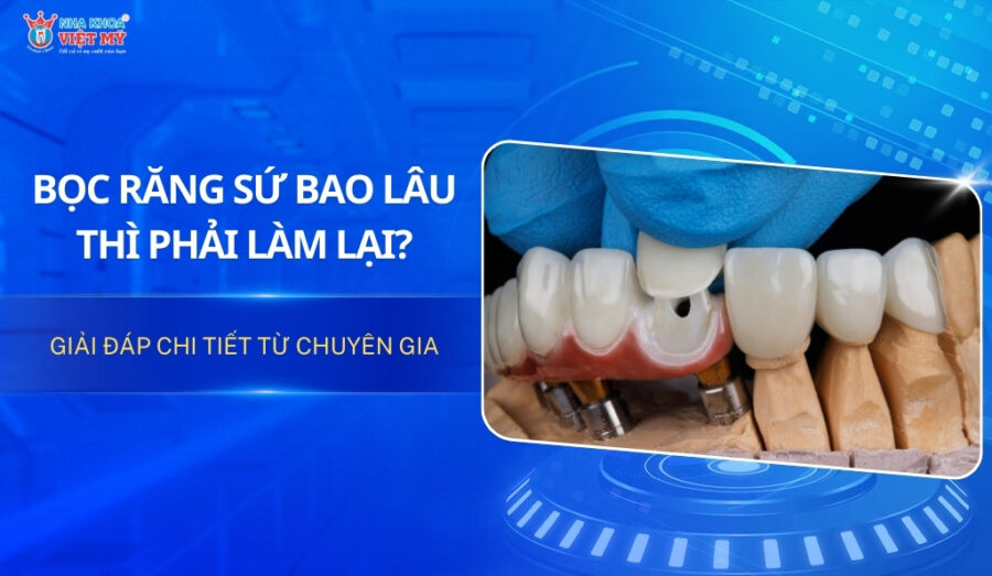 Giải đáp chi tiết: Bọc răng sứ bao lâu thì phải làm lại?