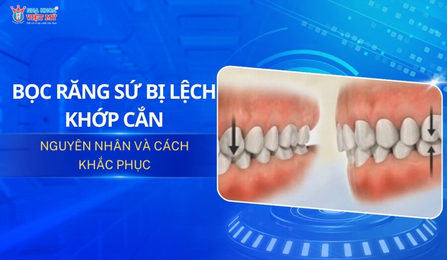 thumbnail bọc răng sứ bị lệch khớp cắn