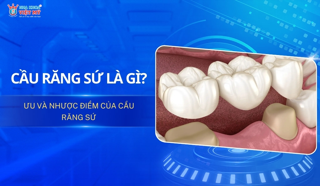 Cầu răng sứ là gì? Ưu và nhược điểm khi làm cầu răng sứ