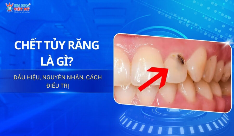 Chết tủy răng là gì? Dấu hiệu, nguyên nhân, cách điều trị