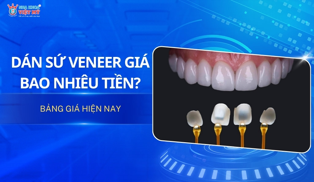 thumbnail dán sứ veneer giá bao nhiêu