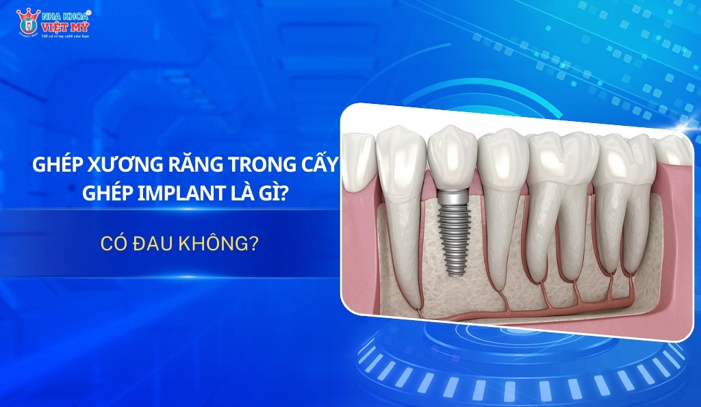 thumbnail ghép xương implant