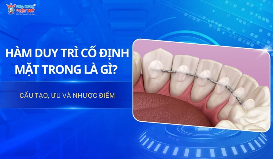 Hàm duy trì cố định mặt trong là gì? Cấu tạo, ưu và nhược điểm